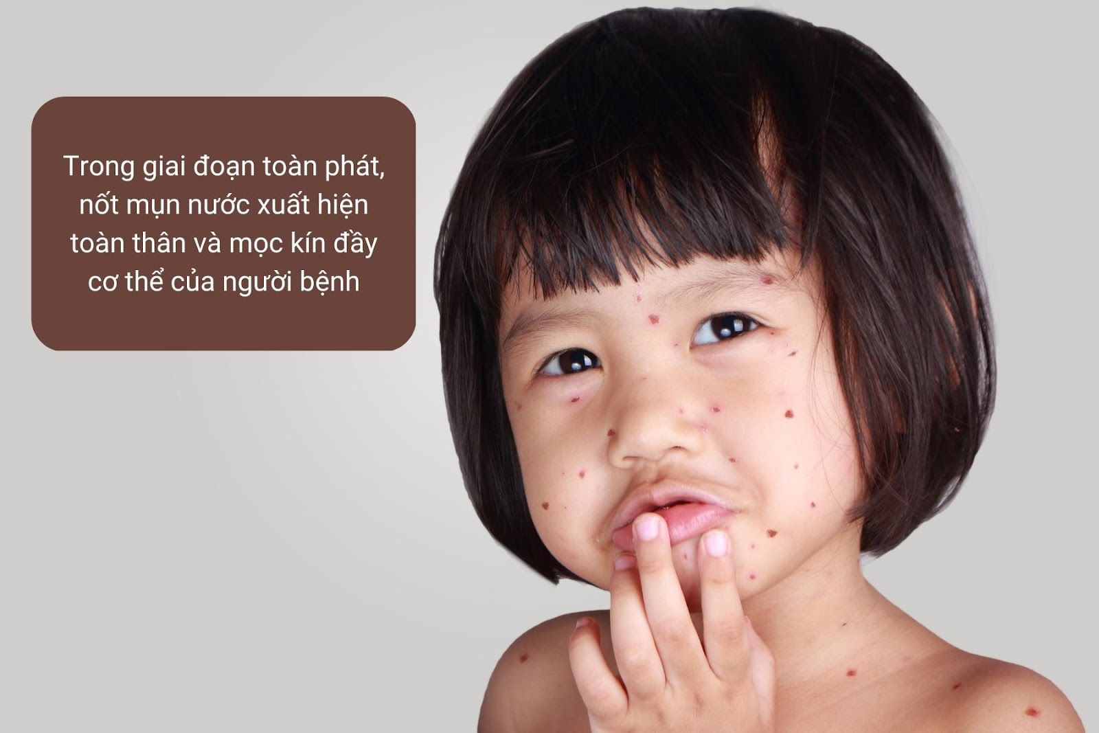 Nốt mụn nước xuất hiện toàn thân và mọc kín đầy cơ thể của người bệnh - Nguồn ảnh: Canva
