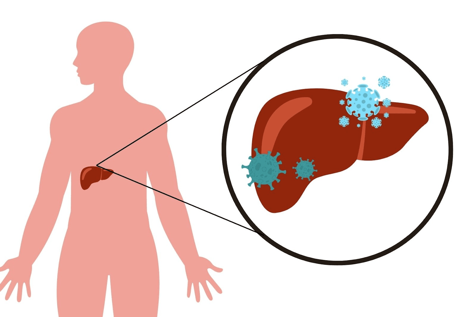 Viêm gan B là bệnh truyền nhiễm do virus gây ra làm tổn thương gan&nbsp;