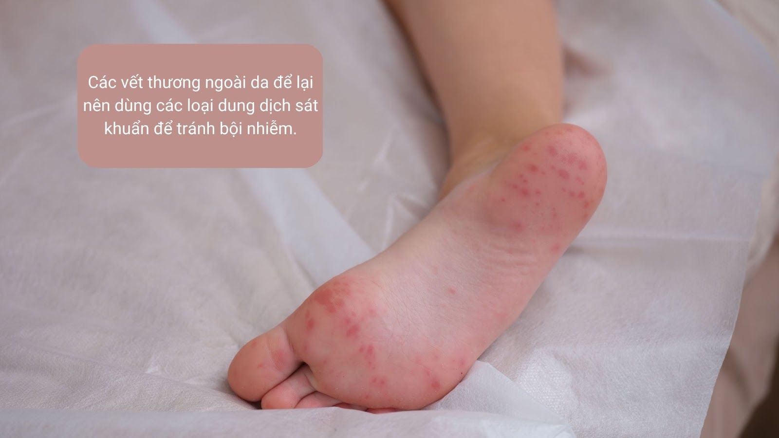 Xử lý các vết thương ngoài da bằng dung dịch sát khuẩn - Nguồn: Canva