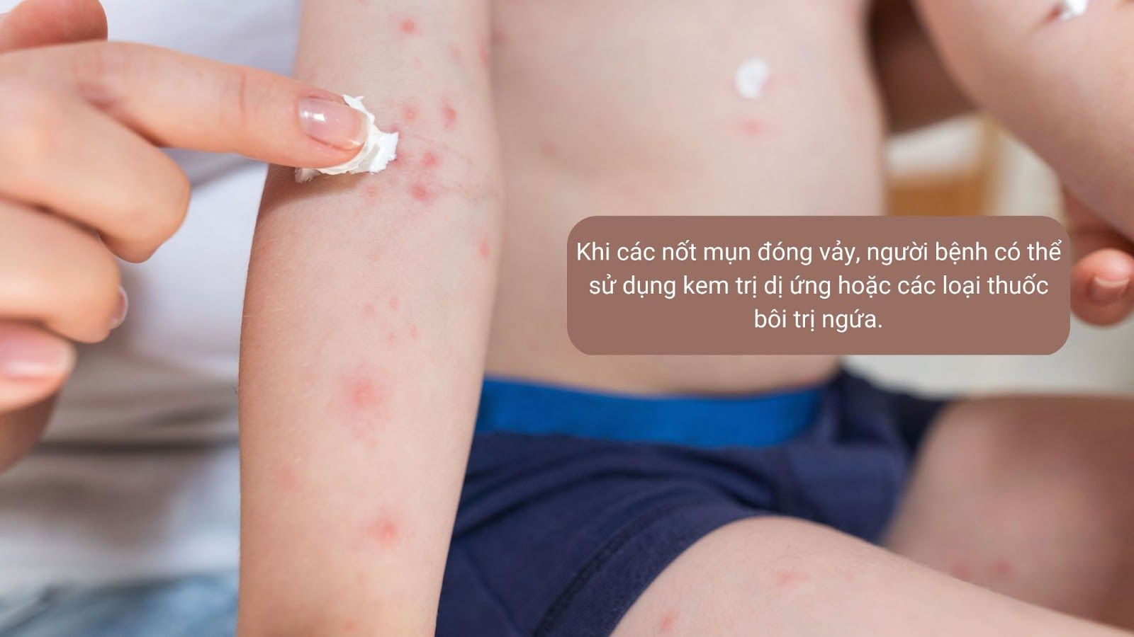 Có thể dùng thuốc để điều trị thủy đậu - Nguồn: Canva