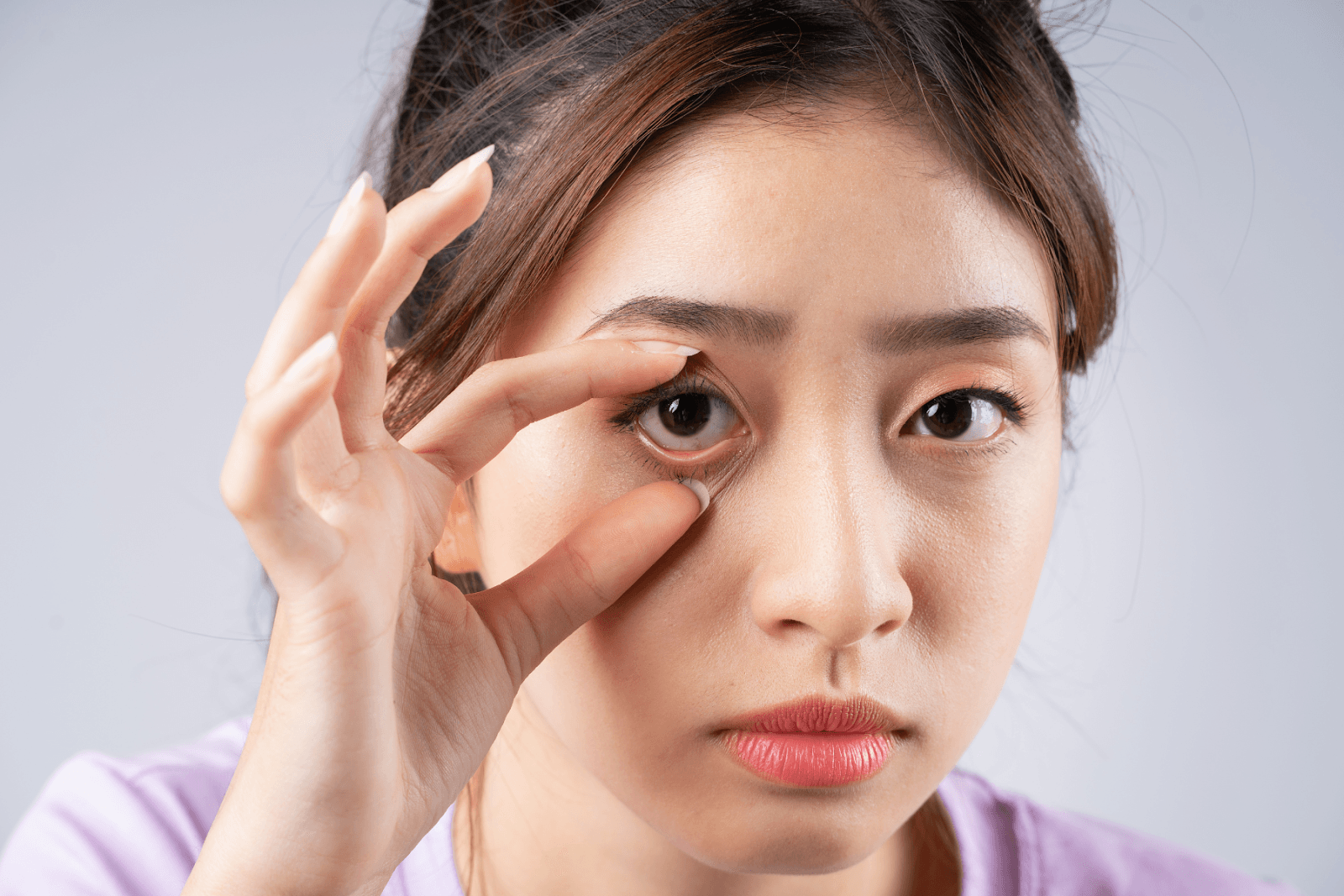 Đau mắt đỏ do nhiều nguyên nhân