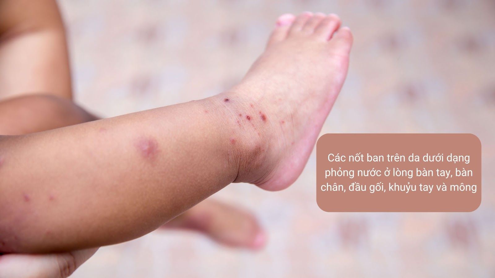 Các nốt ban thường xuất hiện trên da dưới dạng phỏng nước - Nguồn: Canva