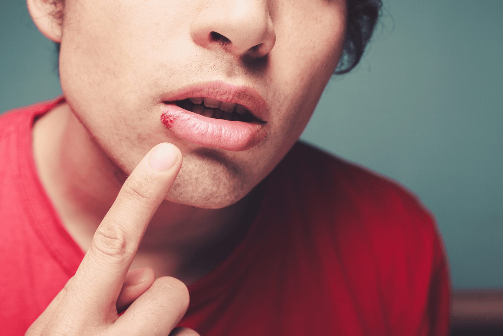 Tìm hiểu cách điều trị lở miệng, loét miệng hiệu quả