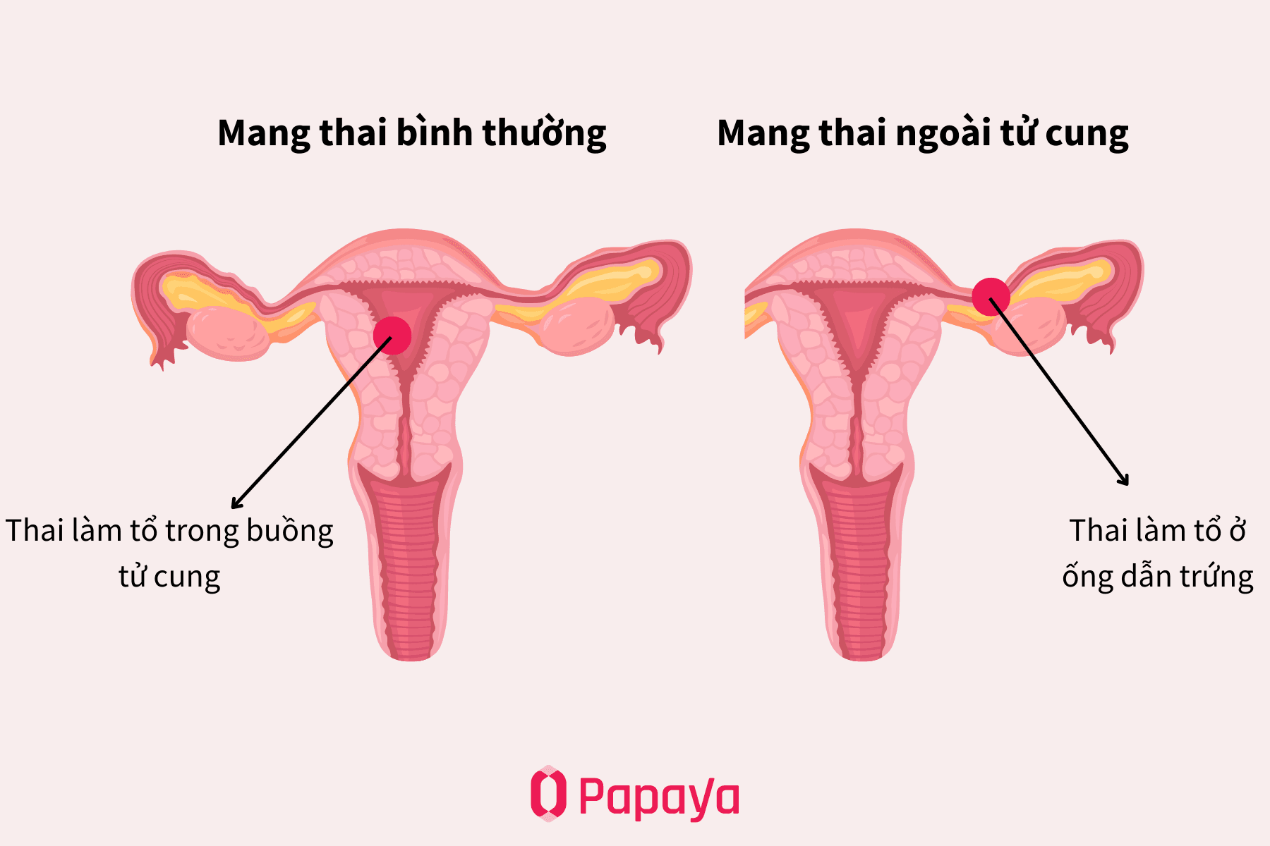 Thai ngoài tử cung được phát hiện sớm không gây nguy hiểm đến phụ nữ