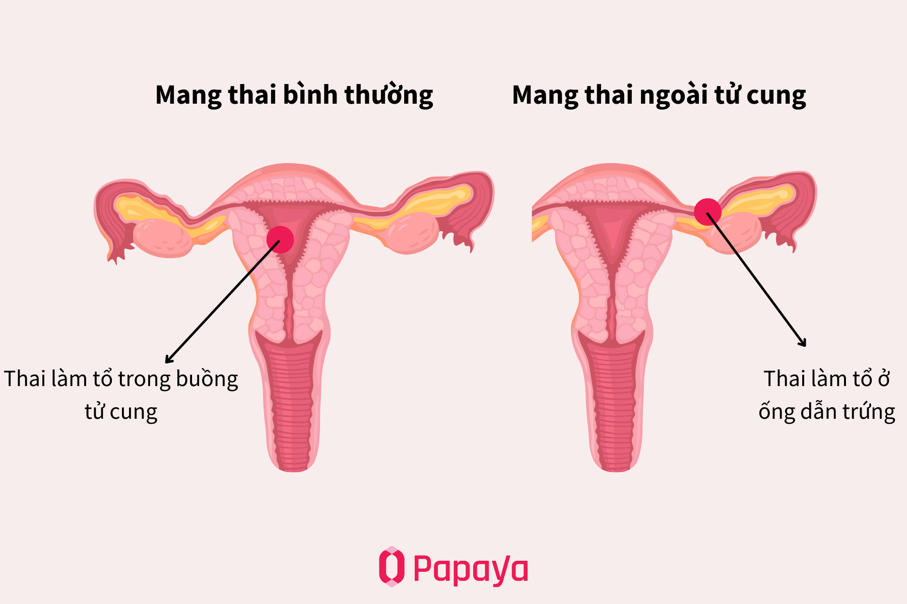 Mang thai ngoài tử cung là một biến chứng nguy hiểm trong thai kỳ