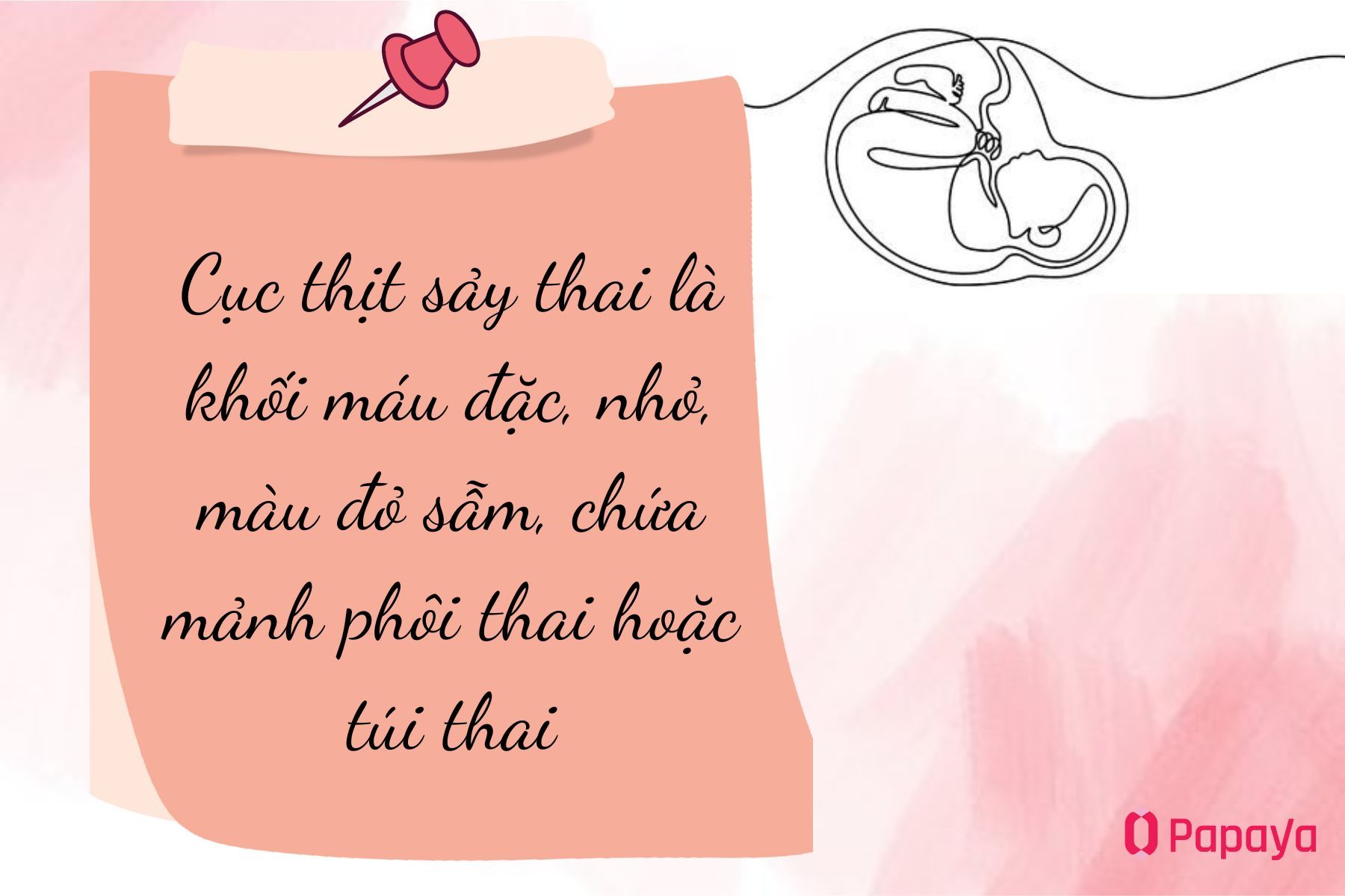 Khái niệm cục thịt sảy thai