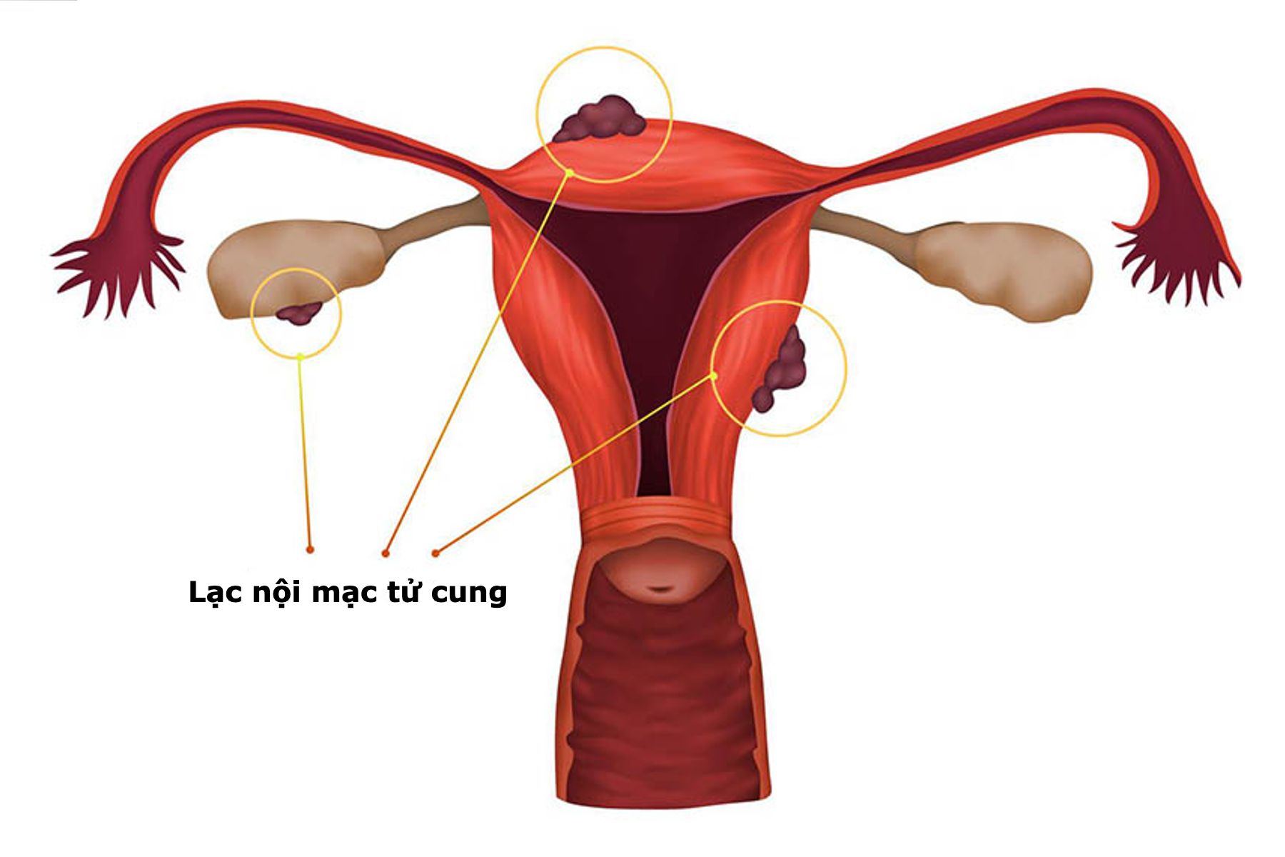 Lạc nội mạc tử cung là một trong những nguyên nhân mang thai ngoài tử cung.