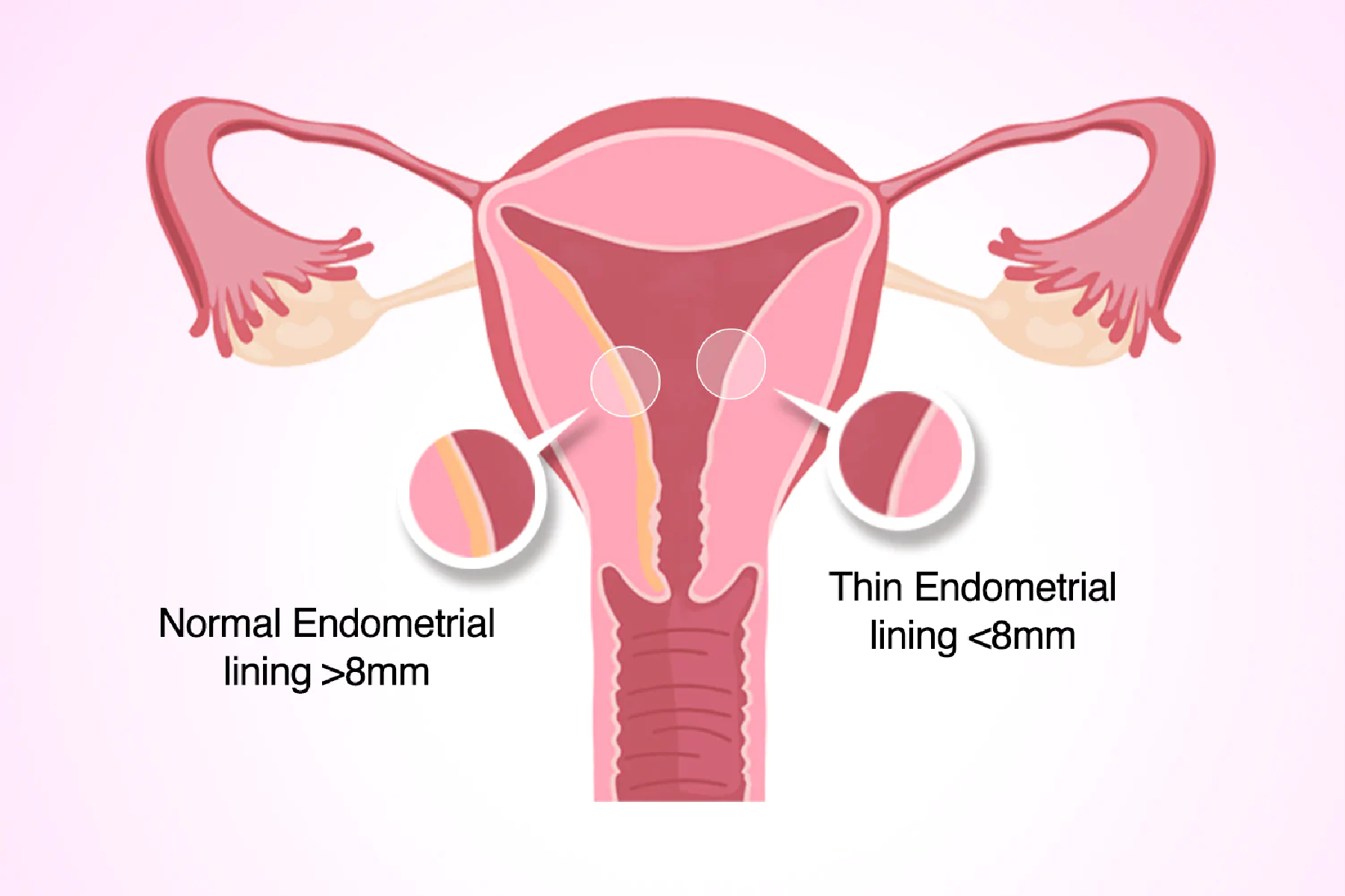Việc thụ thai sẽ trở nên khó hơn khi lớp niêm mạc tử cung có độ dày dưới 7 - 8 mm.