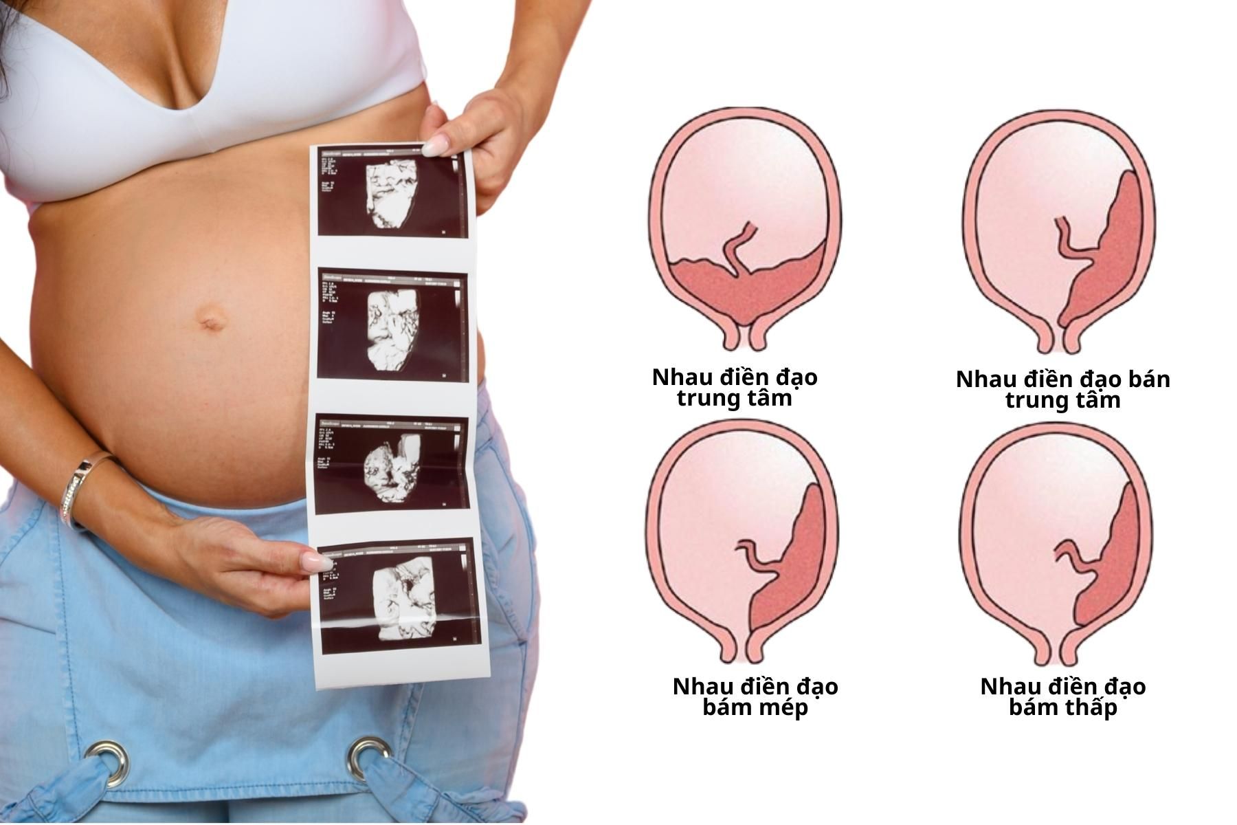 4 loại chính của nhau tiền đạo