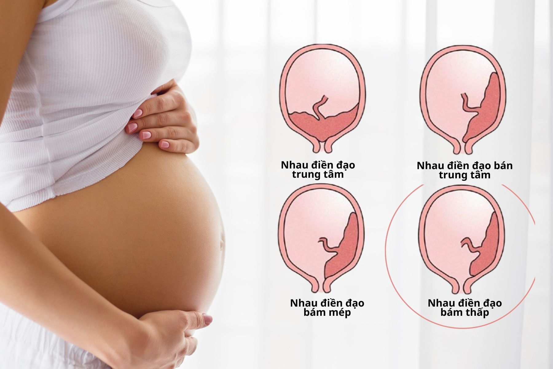 Nhau tiền đạo bám thấp là hiện tượng bất thường về vị trí bám của nhau thai