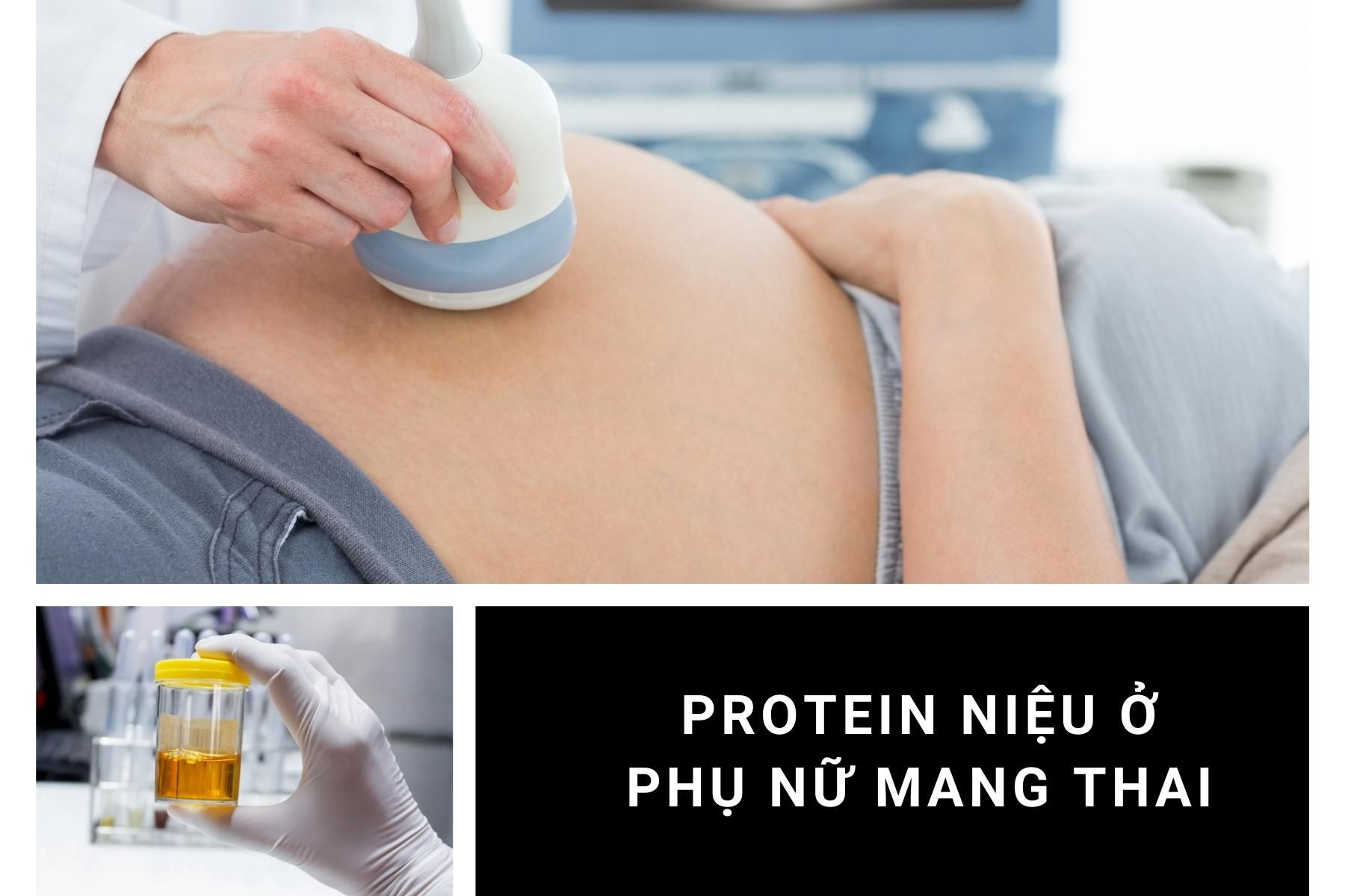 Protein niệu trong tiền sản giật rất nguy hiểm cho phụ nữ mang thai