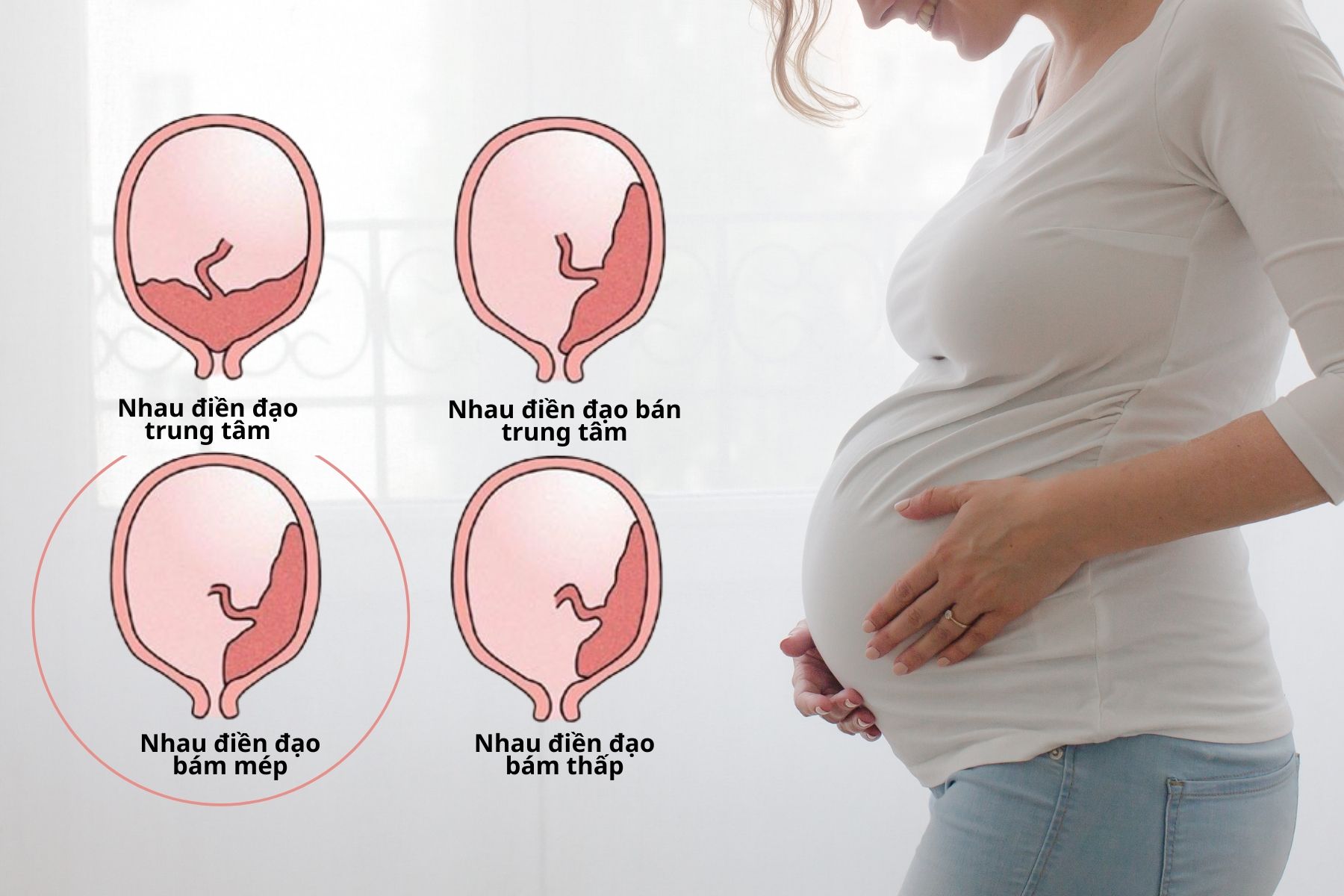 Rau tiền đạo bám mép là tình trạng bánh nhau nằm sát mép của lỗ tử cung