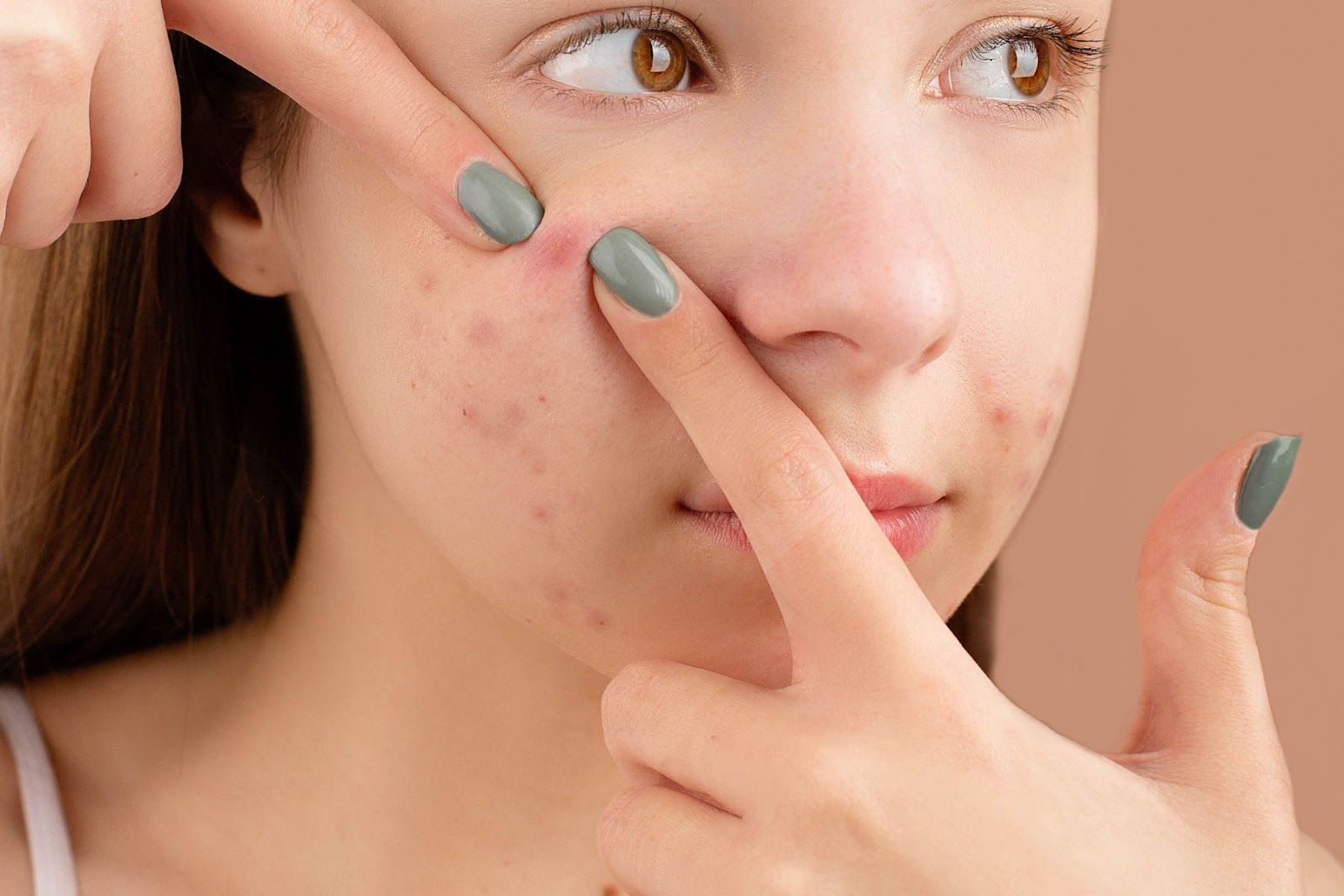 Mật ong rừng có tác dụng giảm thâm mụn trứng cá (Nguồn: Canva)