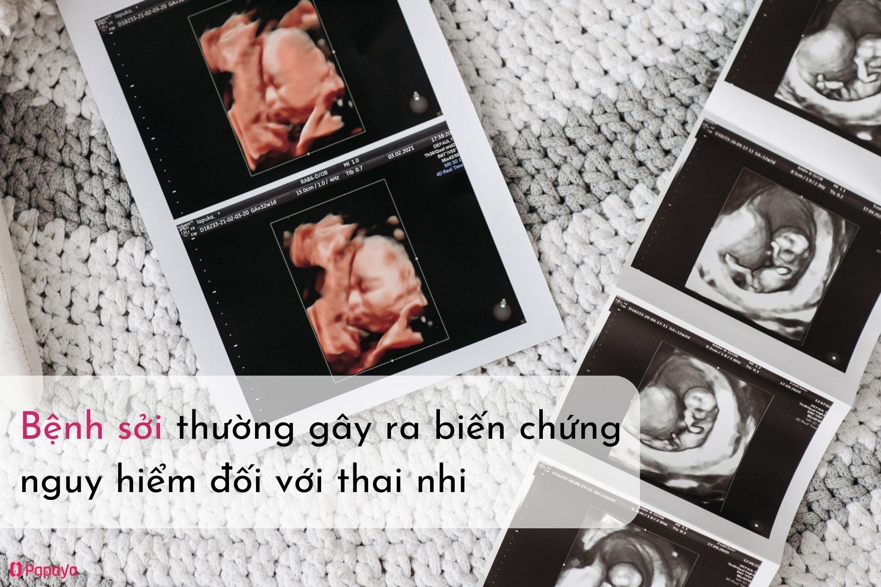 Bệnh sởi gây ra biến chứng nguy hiểm đối với phụ nữ mang thai (Nguồn: Canva)