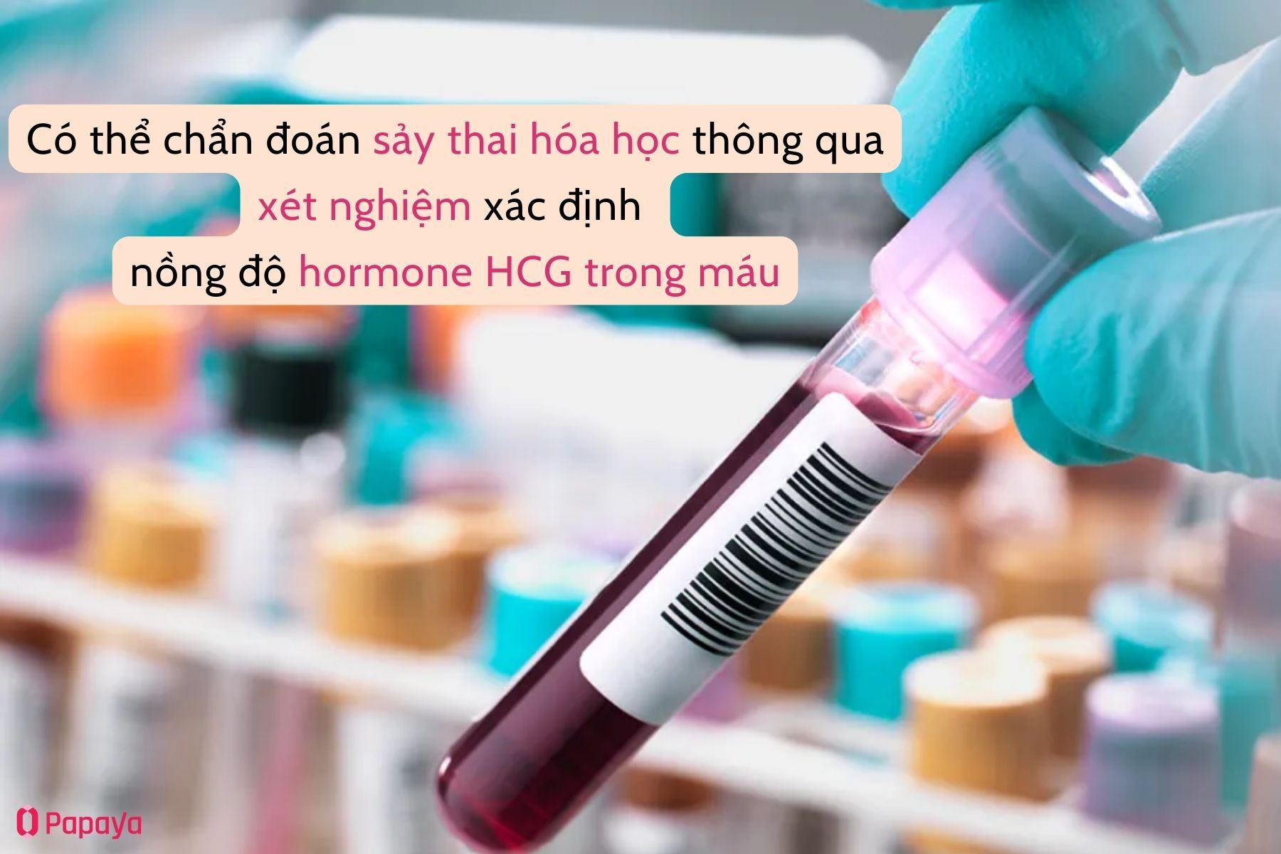 Chẩn đoán sảy thai hóa học bằng xét nghiệm nồng độ HCG